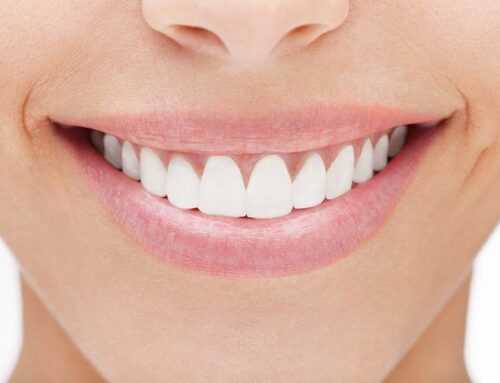 Prepless Veneer: Ihre Lächeln erneuern, ohne Ihre Zähne zu schädigen