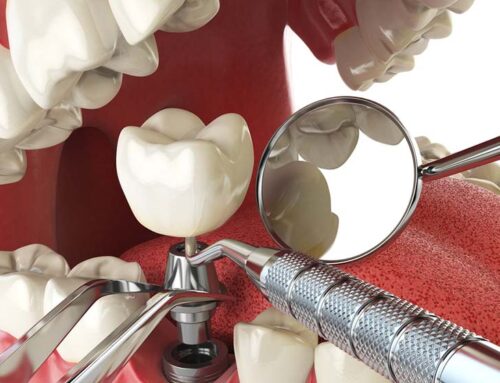 Cleaning and Maintenance of Dental Implants