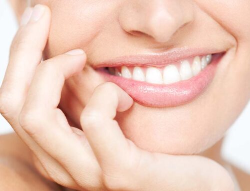 Schritte zur Anwendung von Prepless-Veneers