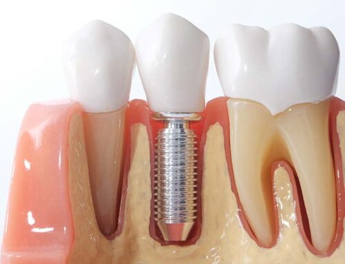 Gum Disease and Implants