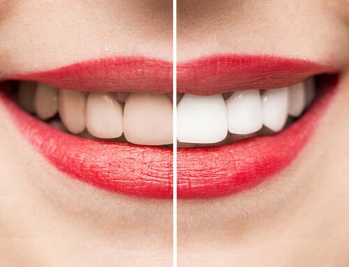 Why Do Teeth Lose Their Whiteness?