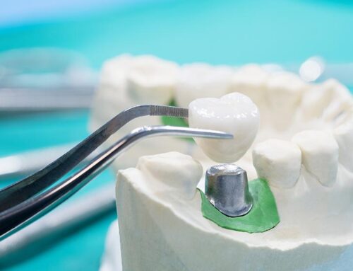 Recovery Process After Dental Implant